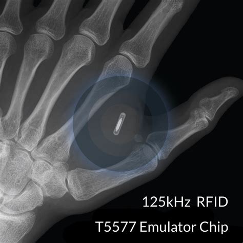 rfid microchip implant